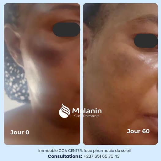 Transformation de peau